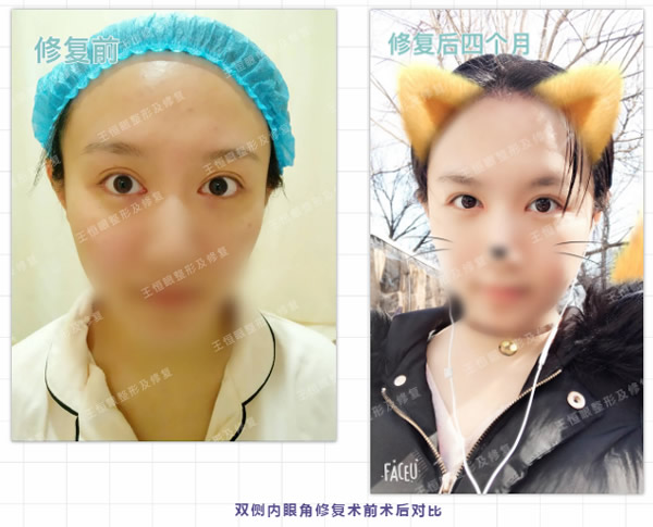 我的內(nèi)眼角修復(fù)成功了,是北京睞美安王恒醫(yī)生修復(fù)的 仙踪老狼免费观看