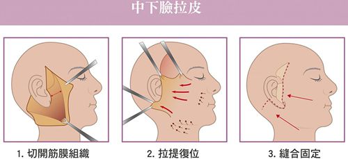 北京大拉皮哪個大夫做的好?大拉皮醫生排名前十中前五名做大拉皮手術尤其好 一本色道a无线码一区v