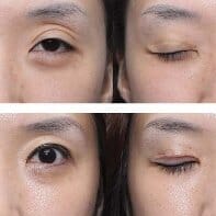 切開雙眼皮需要1000-10000元,價格卻有很大的問題 夫妻二人看片毛毛1级
